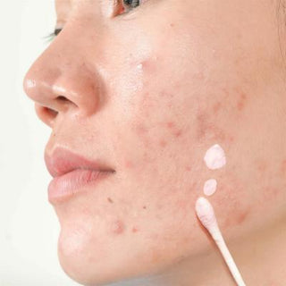 Luv it! Acne Treatment Lotion - Salicylic Acid & Tea Tree Oil for Acne-Prone Skin, 30ml Luv it! Acne Treatment Lotion - Salicylic Acid & Tea Tree Oil acne treatment lotion, salicylic acid skincare, tea tree oil benefits, acne prone skin care, natural acne treatment, skincare, acne solution, natural skincare, salicylic acid benefits, tea tree oil skincare, acne prevention, skincare routine, clear skin, healthy skin, acne care, skincare products