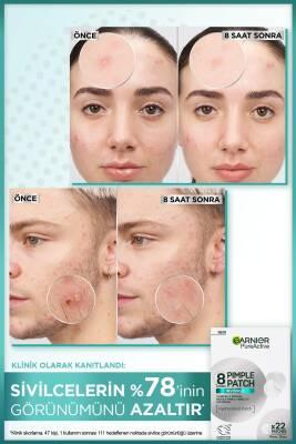 Garnier Pure Active: Anti-Acne Pore Strips with Salicylic Acid & Tea Tree Oil - Blackhead Remover, Facial Cleanser (22 Strips) Garnier Pore Strips: Blackhead Remover with Salicylic Acid pore strips, anti-acne strips, blackhead remover, salicylic acid strips, tea tree oil acne treatment, facial pore cleanser, acne treatment strips, blackhead removal strips, acne treatment, blackhead removal, pore cleansing, salicylic acid, tea tree oil, skincare, beauty, facial care, oily skin, acne-prone skin, blemishes, cl