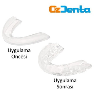 Ozdenta Teeth Grinding Apparatus (Night Plate)